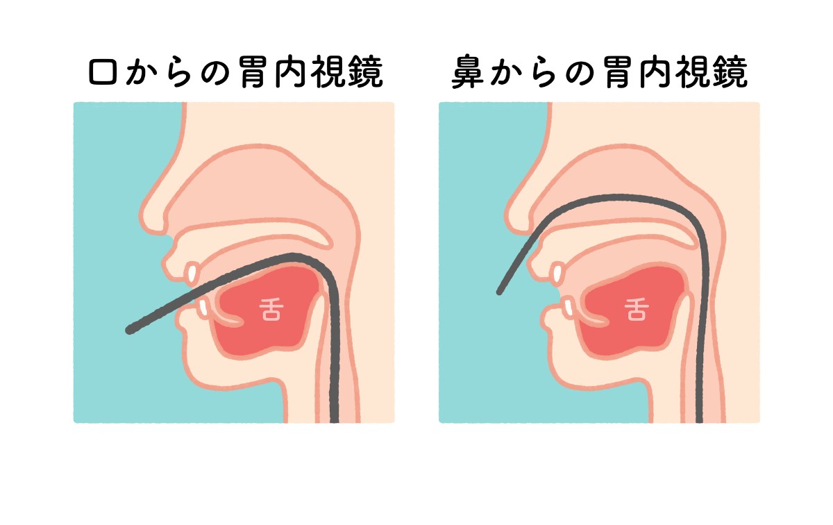 経鼻と経口の違い