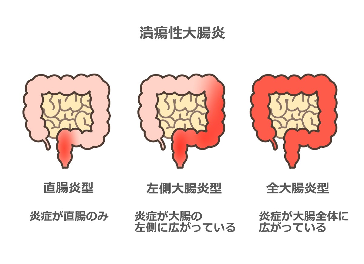 潰瘍性大腸炎（Ulcerative Colitis）について