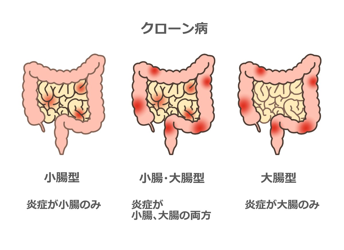クローン病（Crohn’s Disease）について