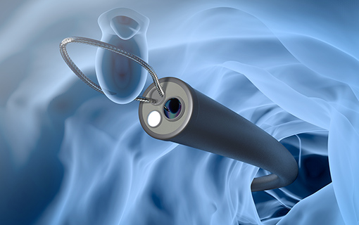 大腸ポリープの切除に対応しています