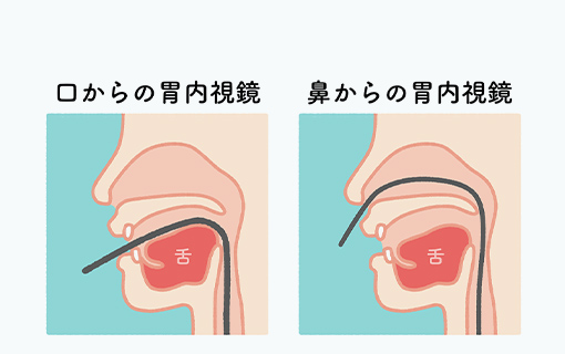 経鼻・経口から選べる胃カメラ検査