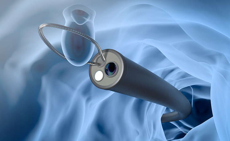 大腸ポリープの切除に対応しています