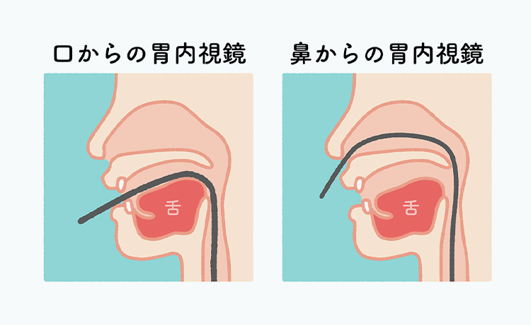 経鼻・経口から選べる胃カメラ検査